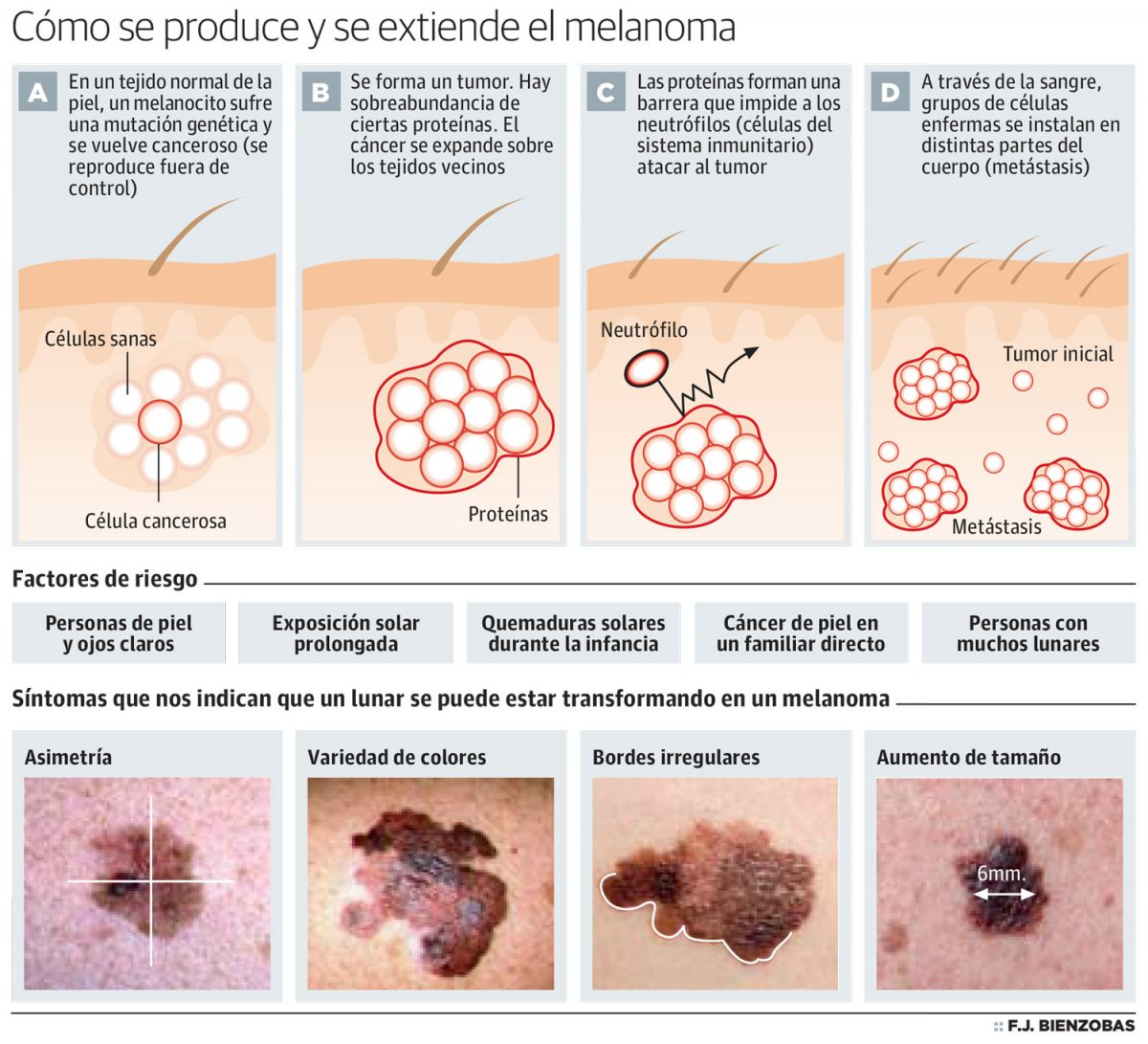 Cómo se produce y se extiende el melanoma 